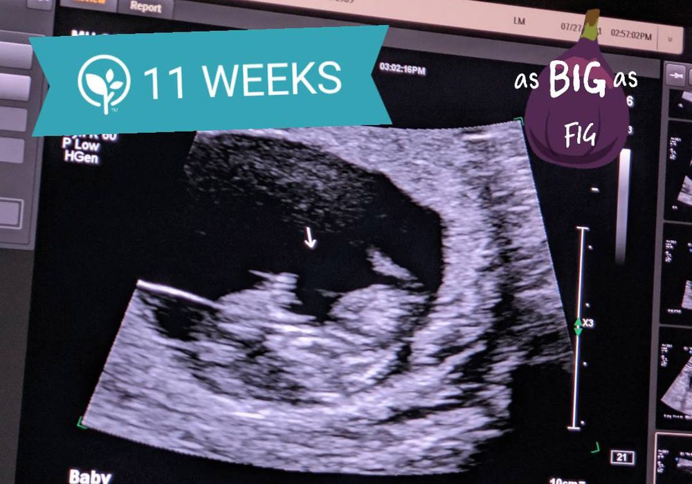 An 11-week ultrasound photo